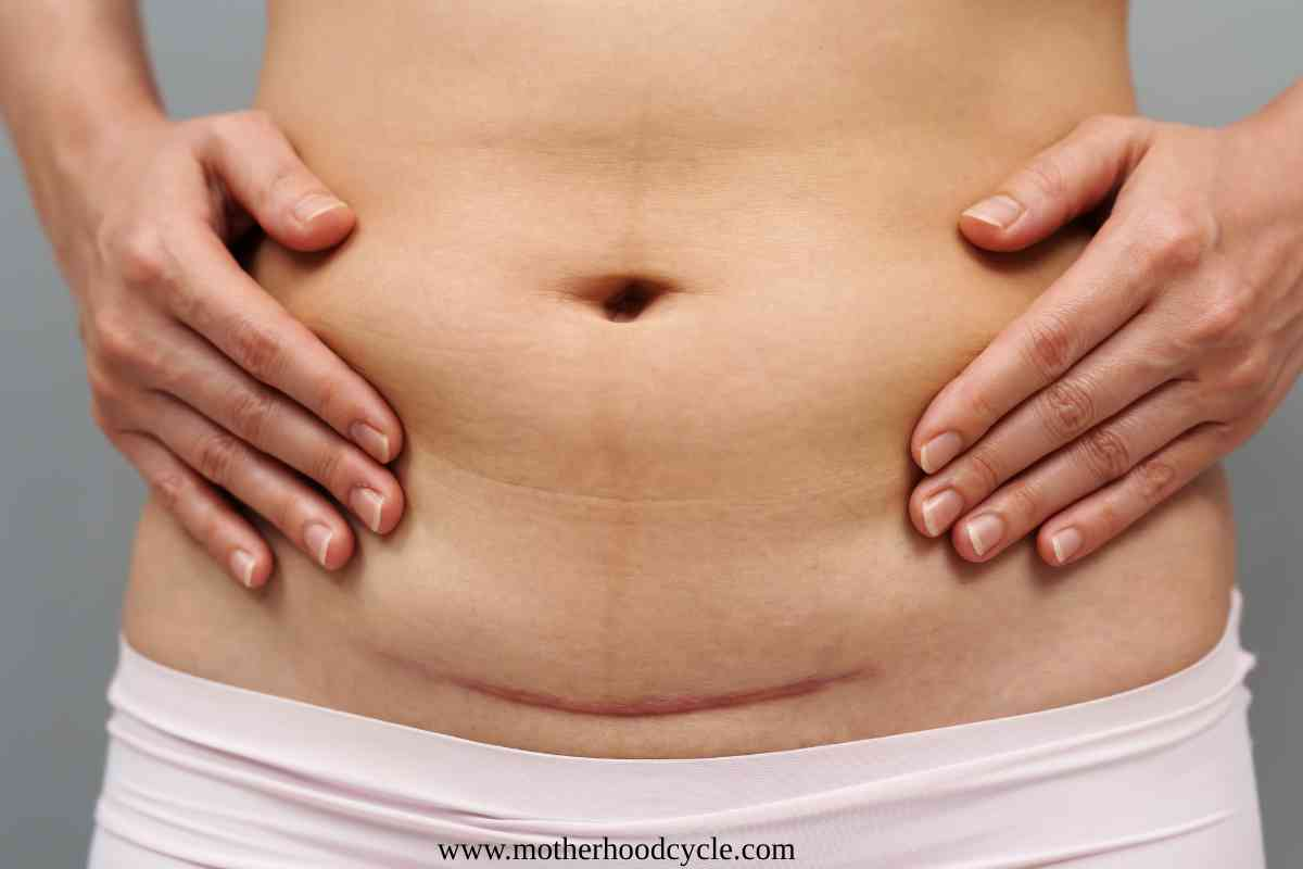 image-of-postpartum-scar-for-C-Section-Recovery-Guide-for-New-Moms-Real-Tips-to-Heal-Faster-and-Feel-Better